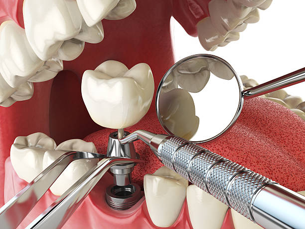 Best Emergency Dental Care for Broken or Chipped Teeth in Ohkay Owingeh, NM